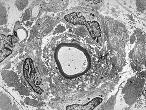 F,23y. | n.suralis - hypertrophic demyelinating neuropathy [onion bulb]